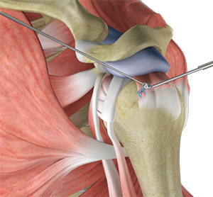 Rotator Cuff Repair