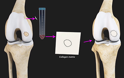 Autologous Chondrocyte Implantation