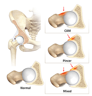 Cam Pincer Impingement