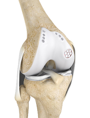 Cartilage Restoration