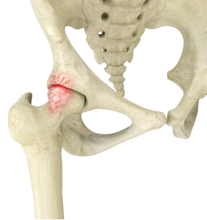 Femoroacetabular Impingement