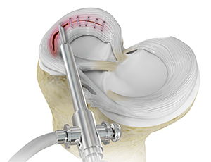 Meniscal repair