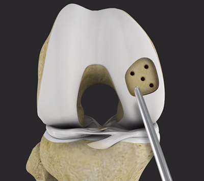 Microfracture