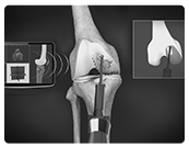 Robotic Hip & Knee Replacement Surgery