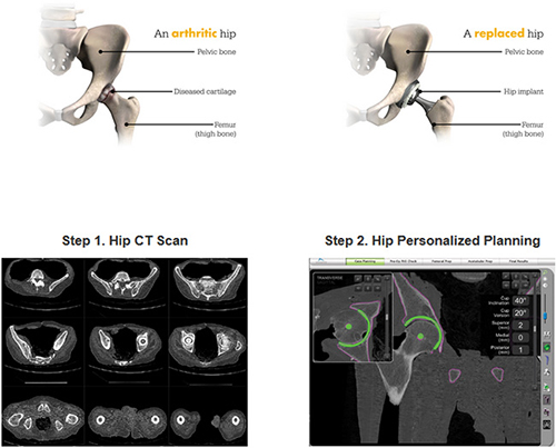 Robotic Hip